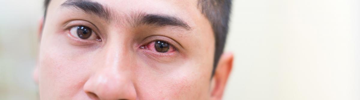 closeup of mans face with red eye, anterior uveitis or swollen red eye