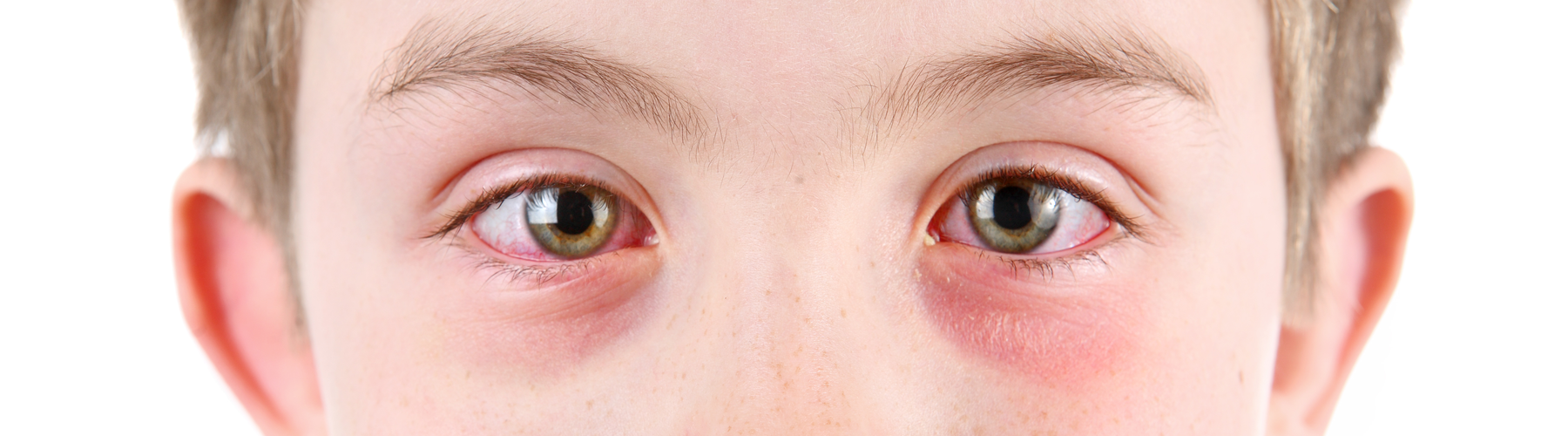 Are Eye Infections Contagious 